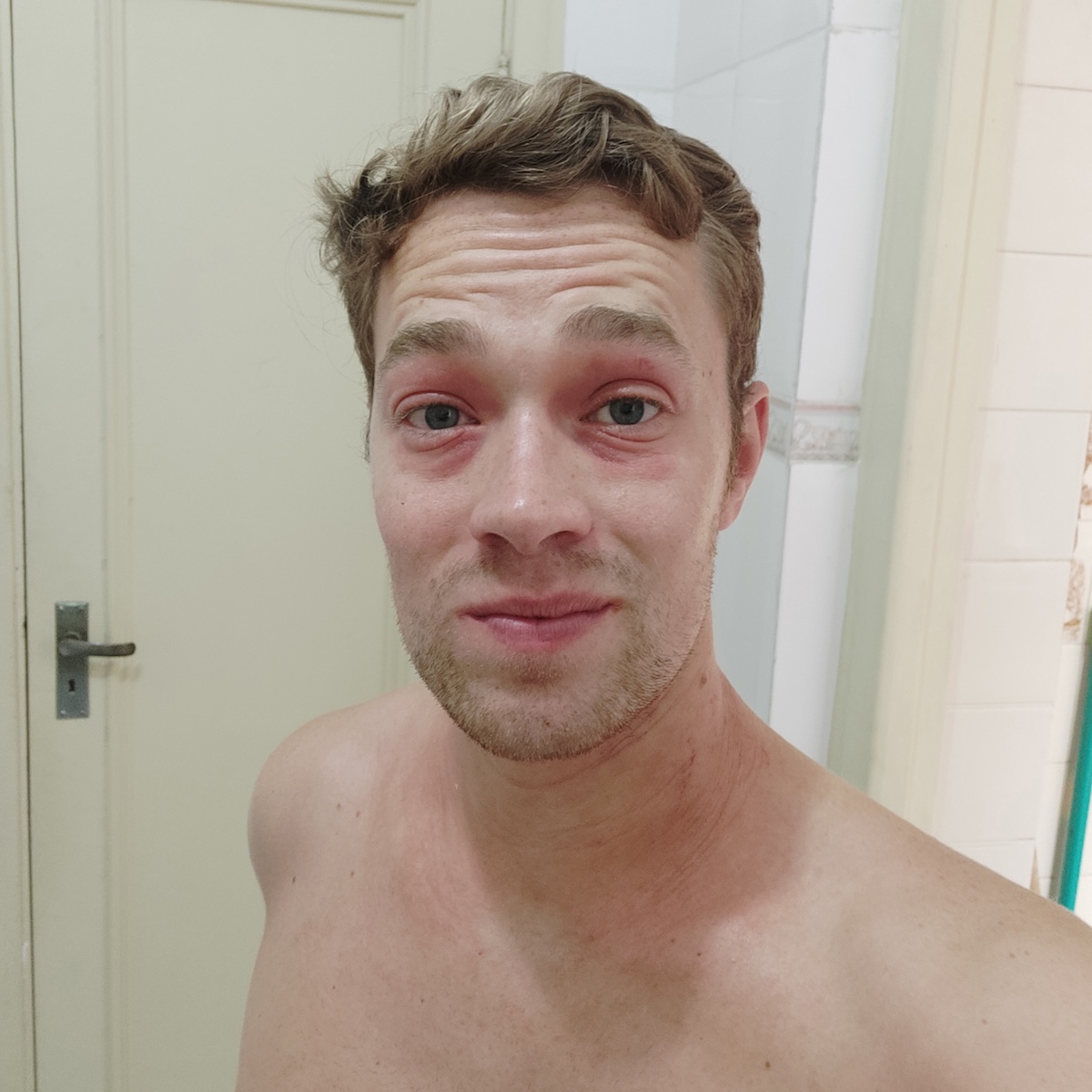 Haut vorher - mit Neurodermitis